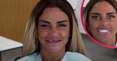 katie price teeth before and after|Katie Prices veneer falls out live on her TikTok